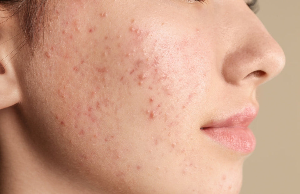 Acne-Prone Skin