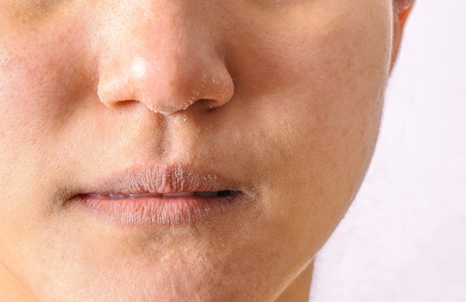 Dull, Dry Skin
