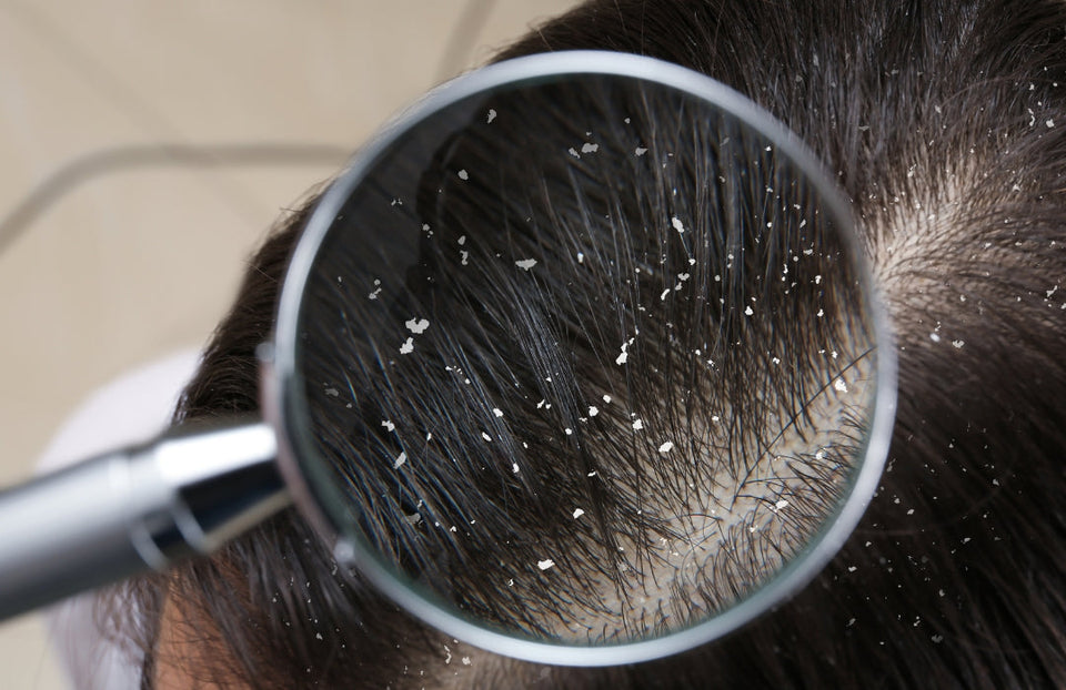 Dandruff