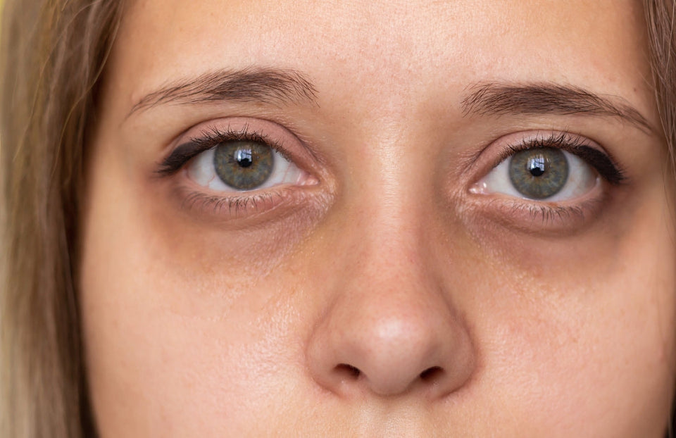 Dark Circles