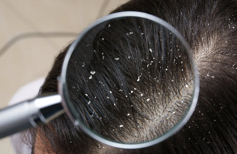 Dandruff