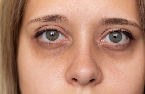 Dark Circles