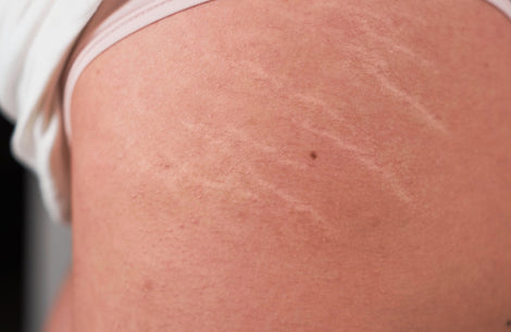 Stretchmarks